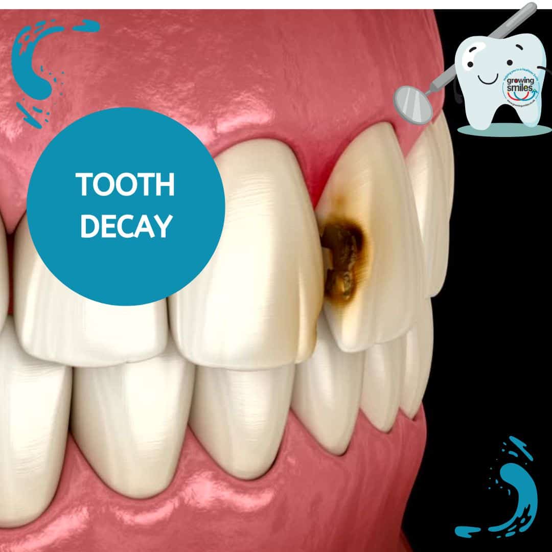 Not today, tooth decay! - Growing Smiles
