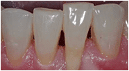 An image of teeth showing where the teeth make contact with each other