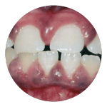Bleeding gums (gingivitis) in a 7-13 year old child 