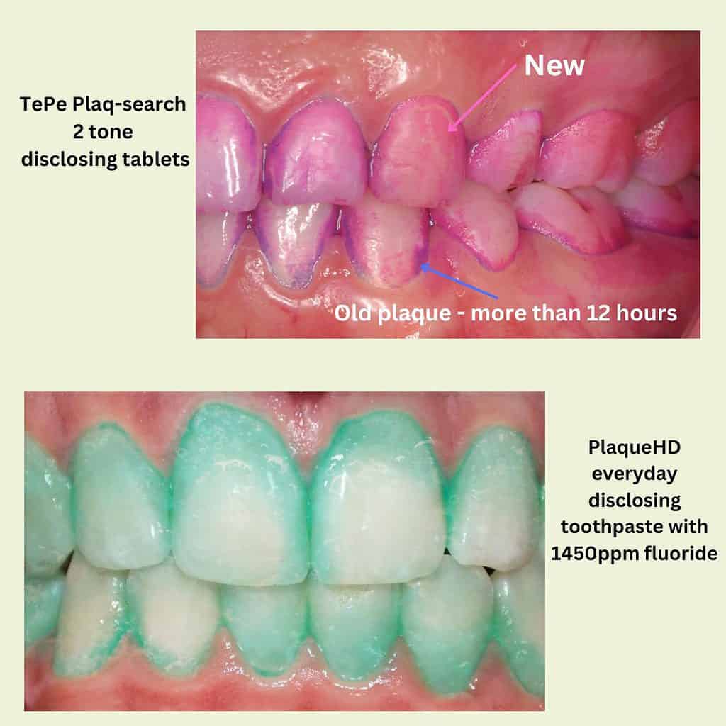 Disclose plaque on teeth