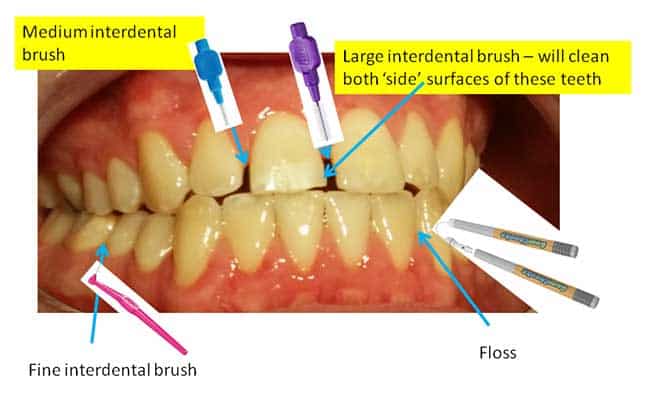 An image showing the different sizes of interdental brushes/floss to use between teeth