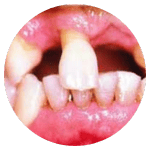 gum disease 65 plus