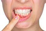 gum disease image