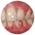 gum disease