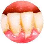 gum disease