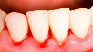 gum disease videos