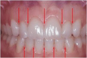 An image of teeth showing where the teeth make contact with each other
