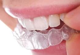 image showing dental appliance 