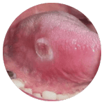oral cancer image
