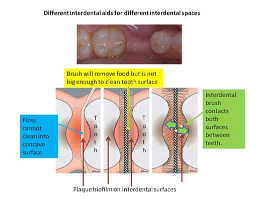 Different aids for different interdental spaces