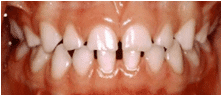 An image of teeth showing where the teeth make contact with each other