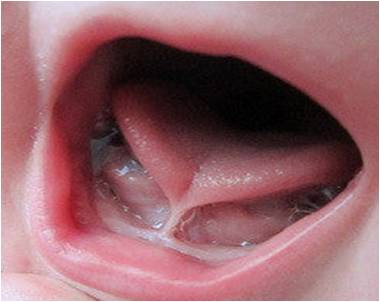 image showing tongue tie