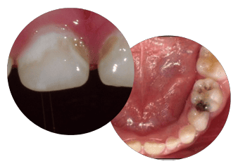 tooth decay (dental caries) on teeth that belong to a 3-6 year old child