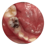 Tooth decay in a 7-13 year old child