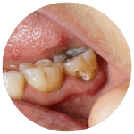 image showing tooth decay