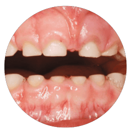 tooth wear (erosion, attrition) on a 3-6 year old child