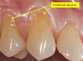 Image showing toothbrush abrasion