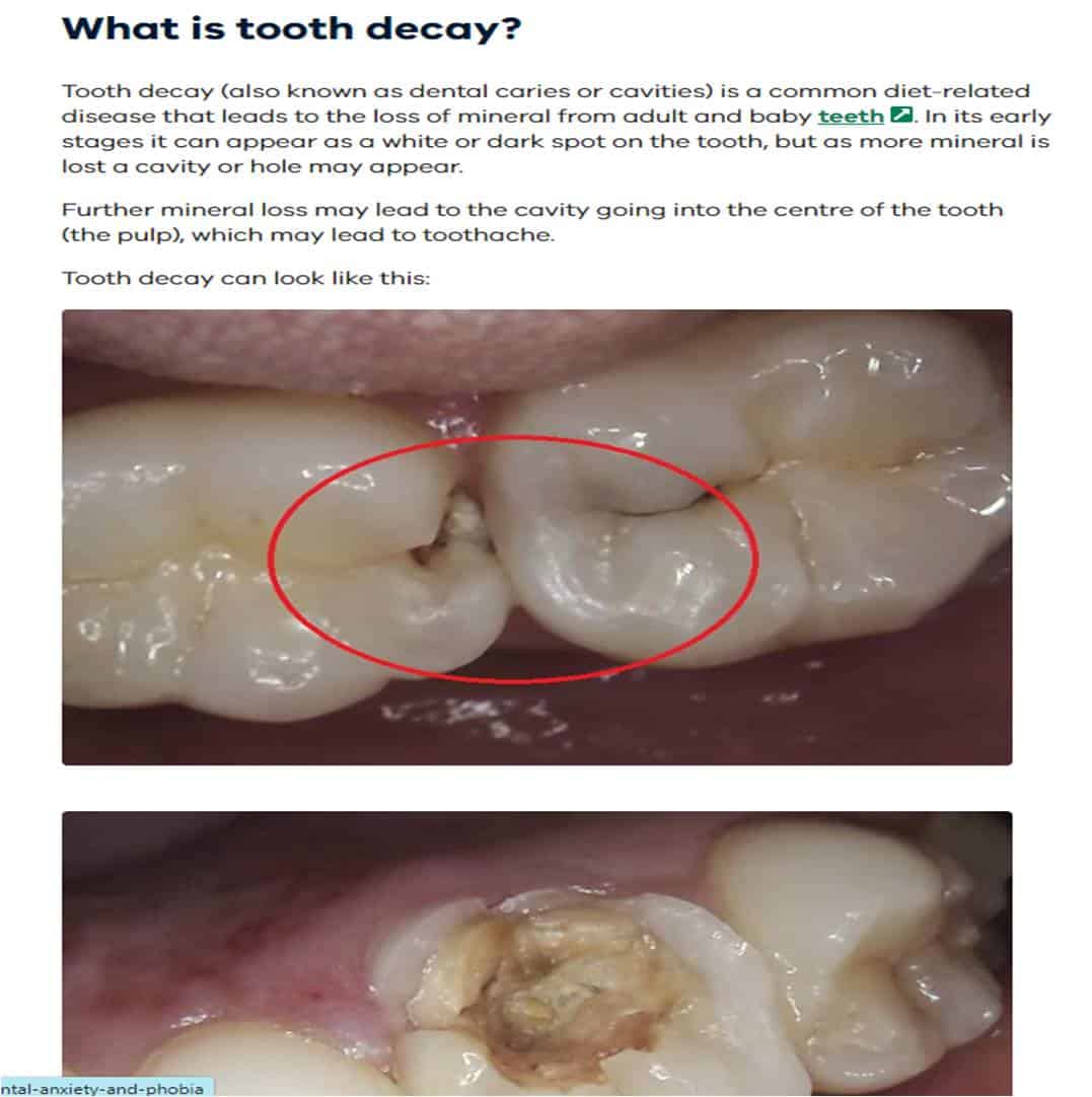 Molar tooth deals decay